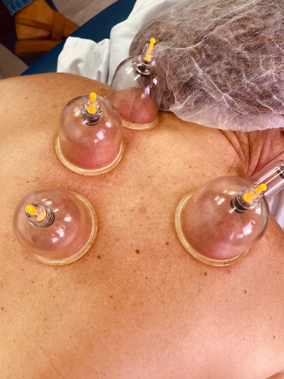 Ventosaterapia — técnica de ventosas